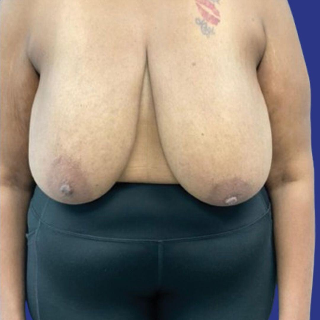 Procedure before and after - before