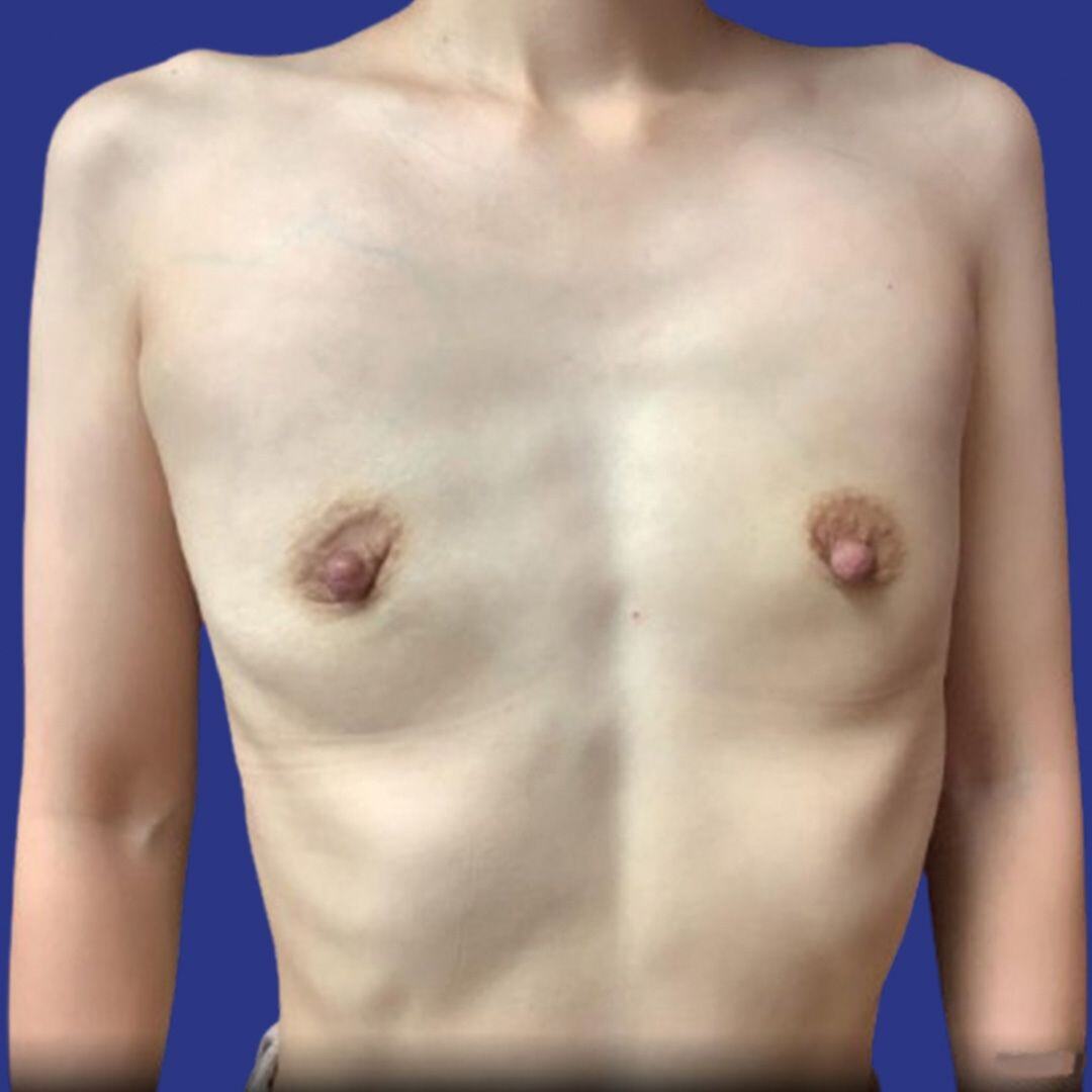 Procedure before and after - before