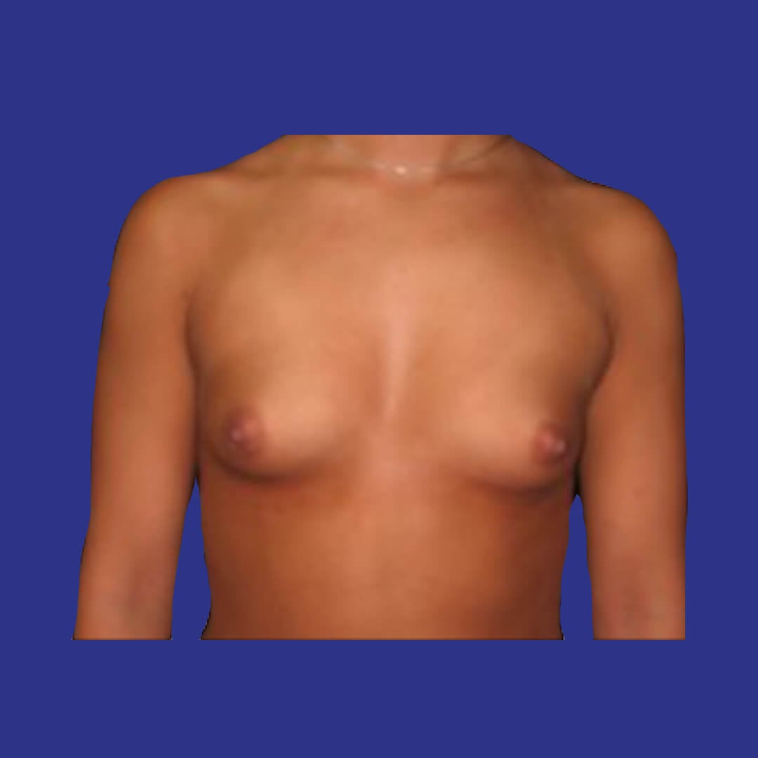 Procedure before and after - before