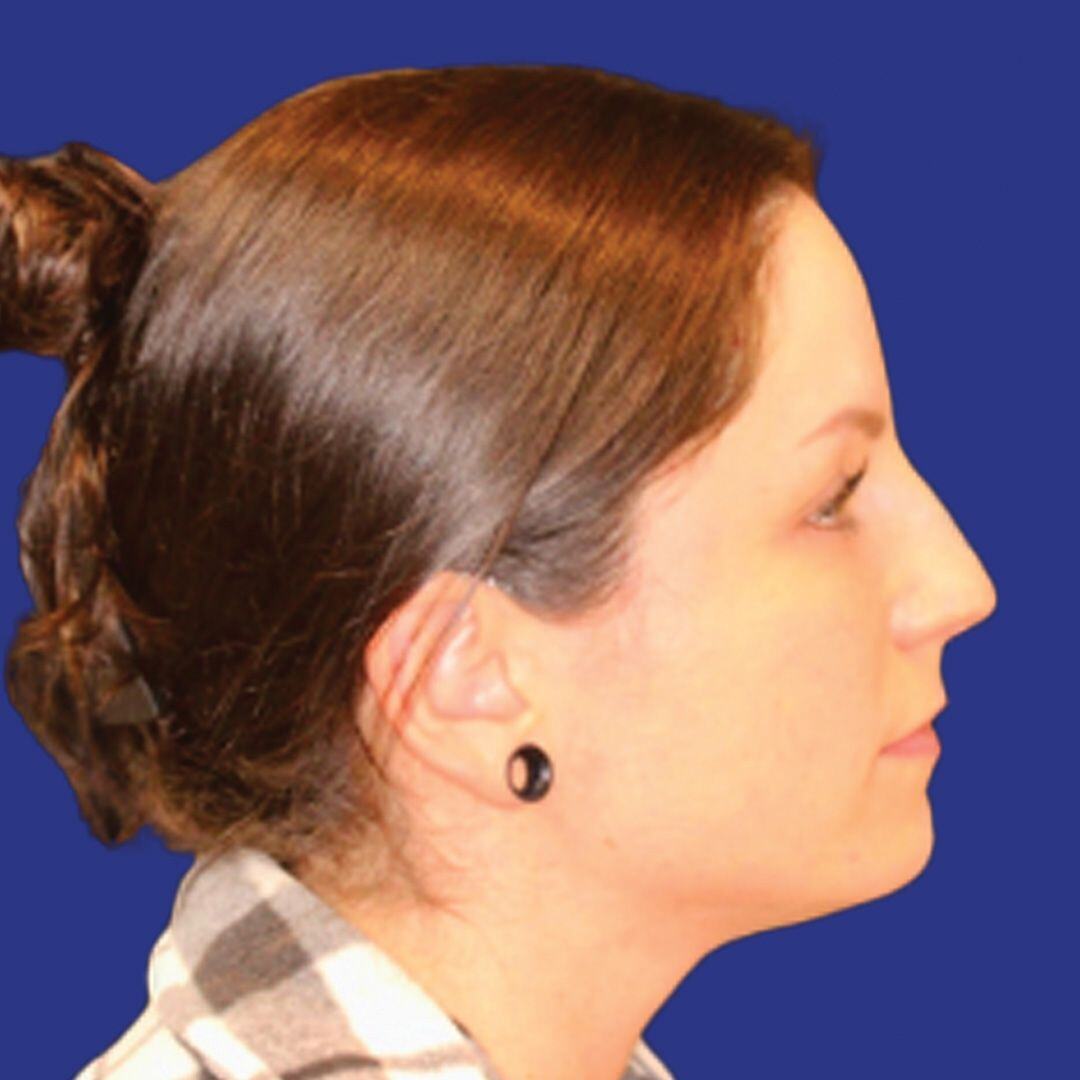 Procedure before and after - before