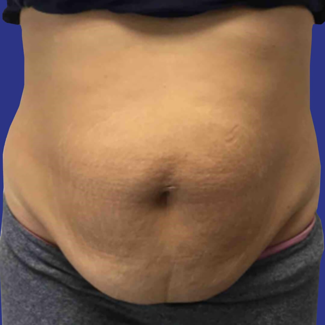 Procedure before and after - before