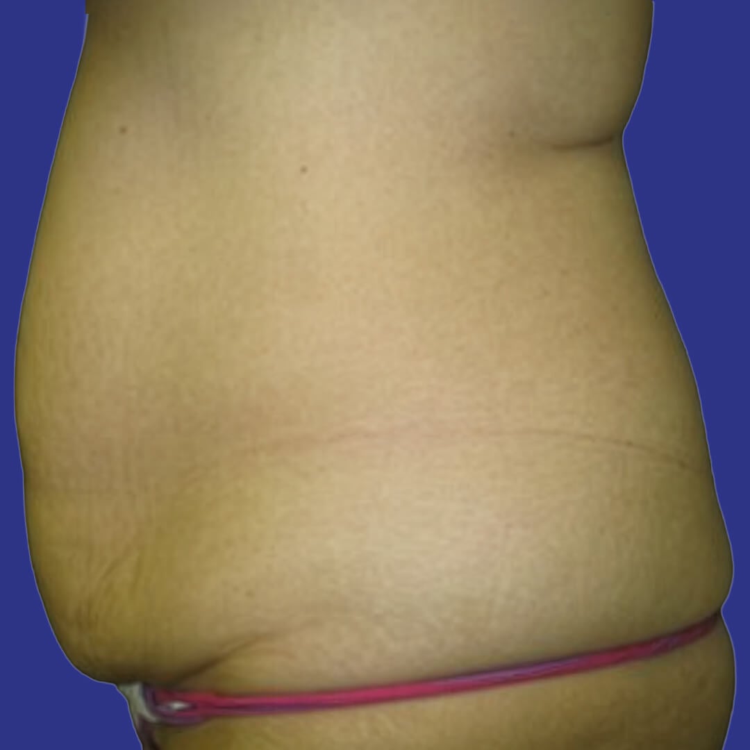 Procedure before and after - before