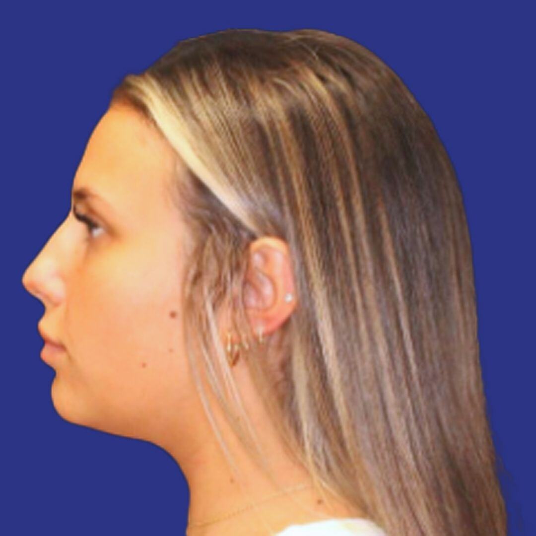 Procedure before and after - before