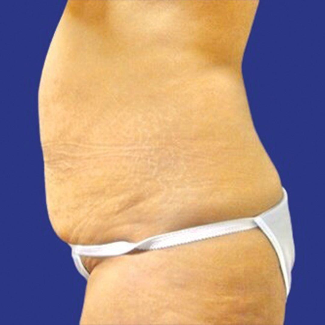 Procedure before and after - before