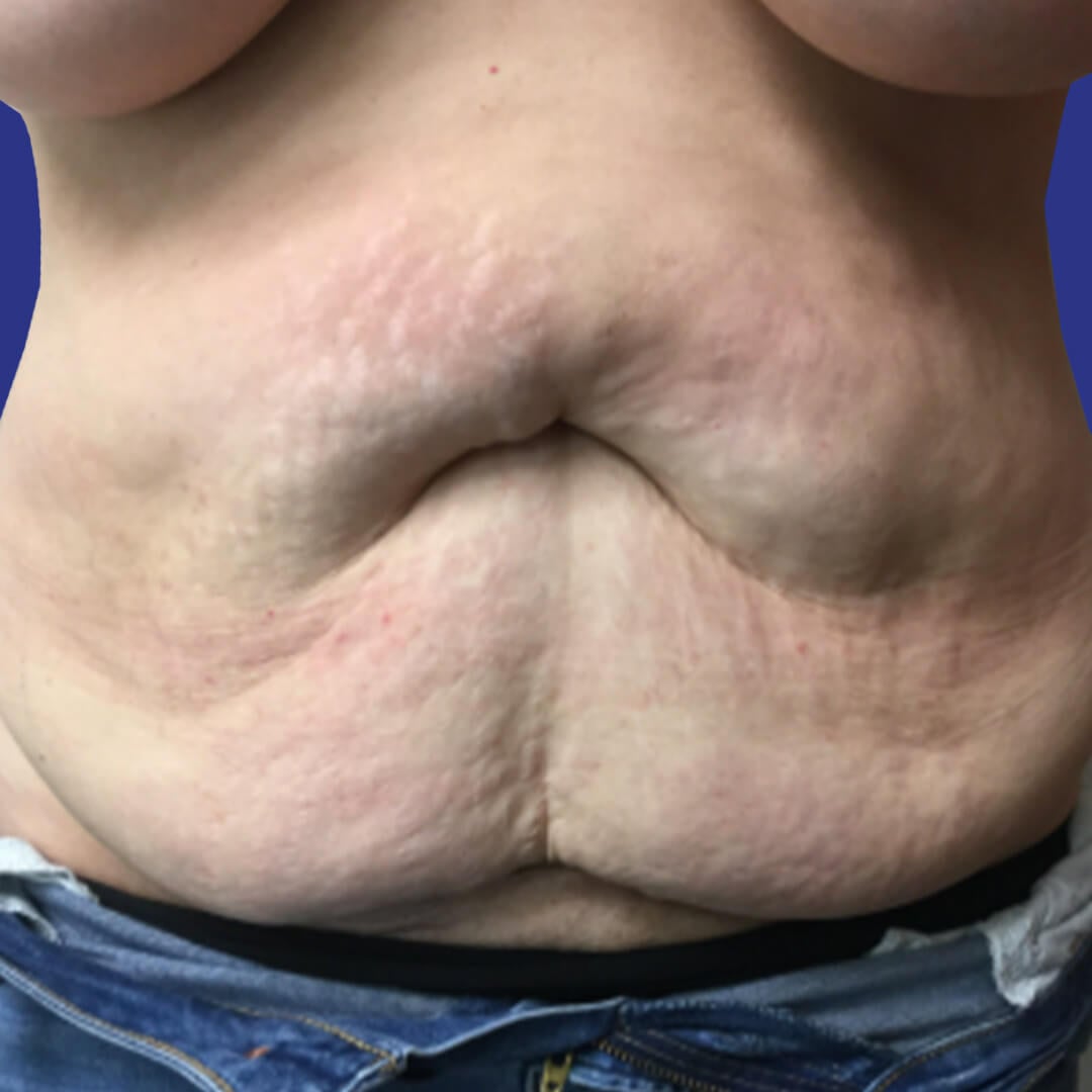 Procedure before and after - before