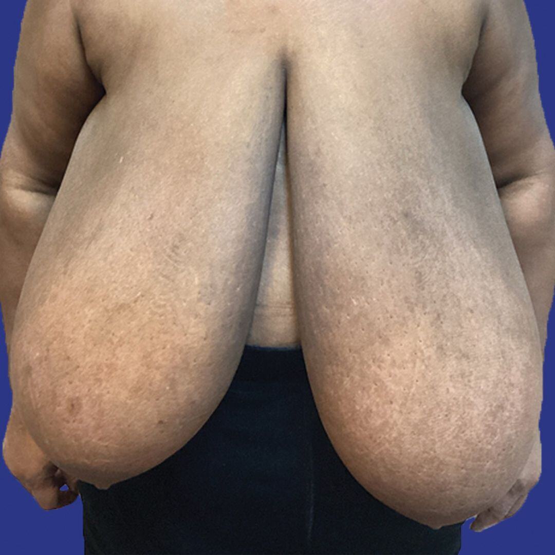 Procedure before and after - before