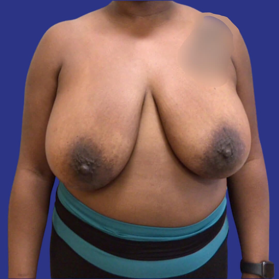 Procedure before and after - before
