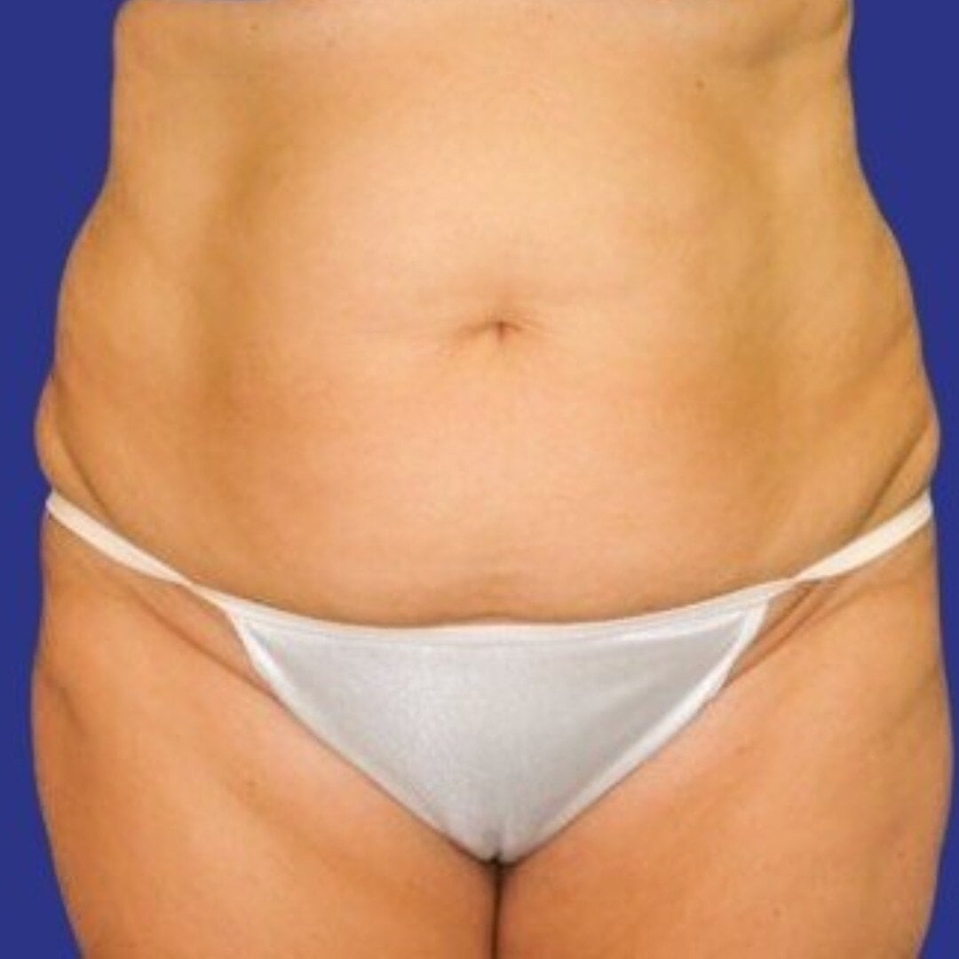 Procedure before and after - before