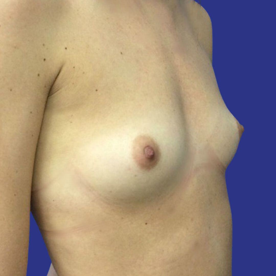 Procedure before and after - before