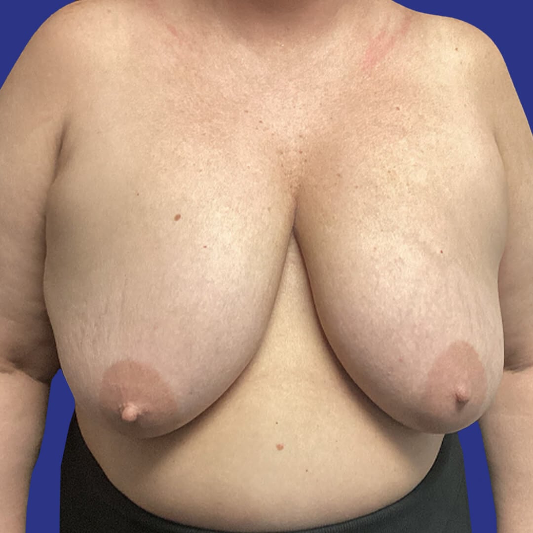 Procedure before and after - before