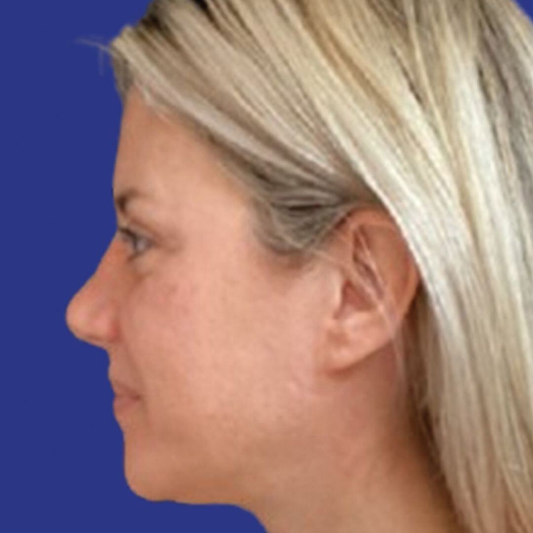 Procedure before and after - before