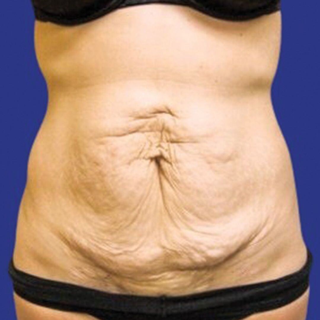 Procedure before and after - before