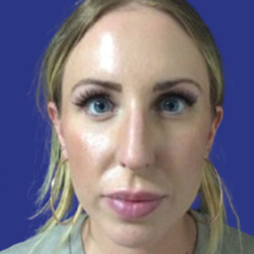 Procedure before and after - before