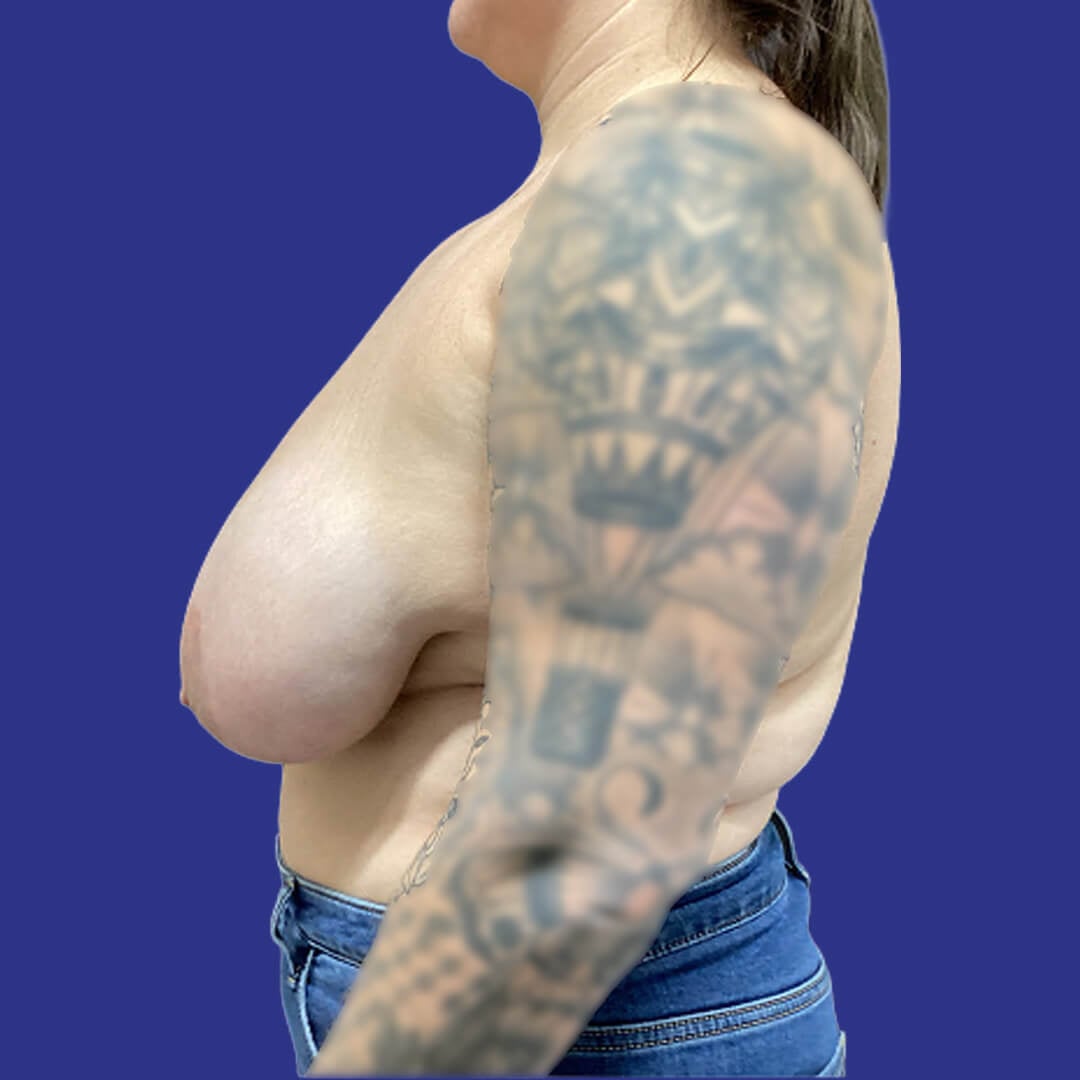 Procedure before and after - before