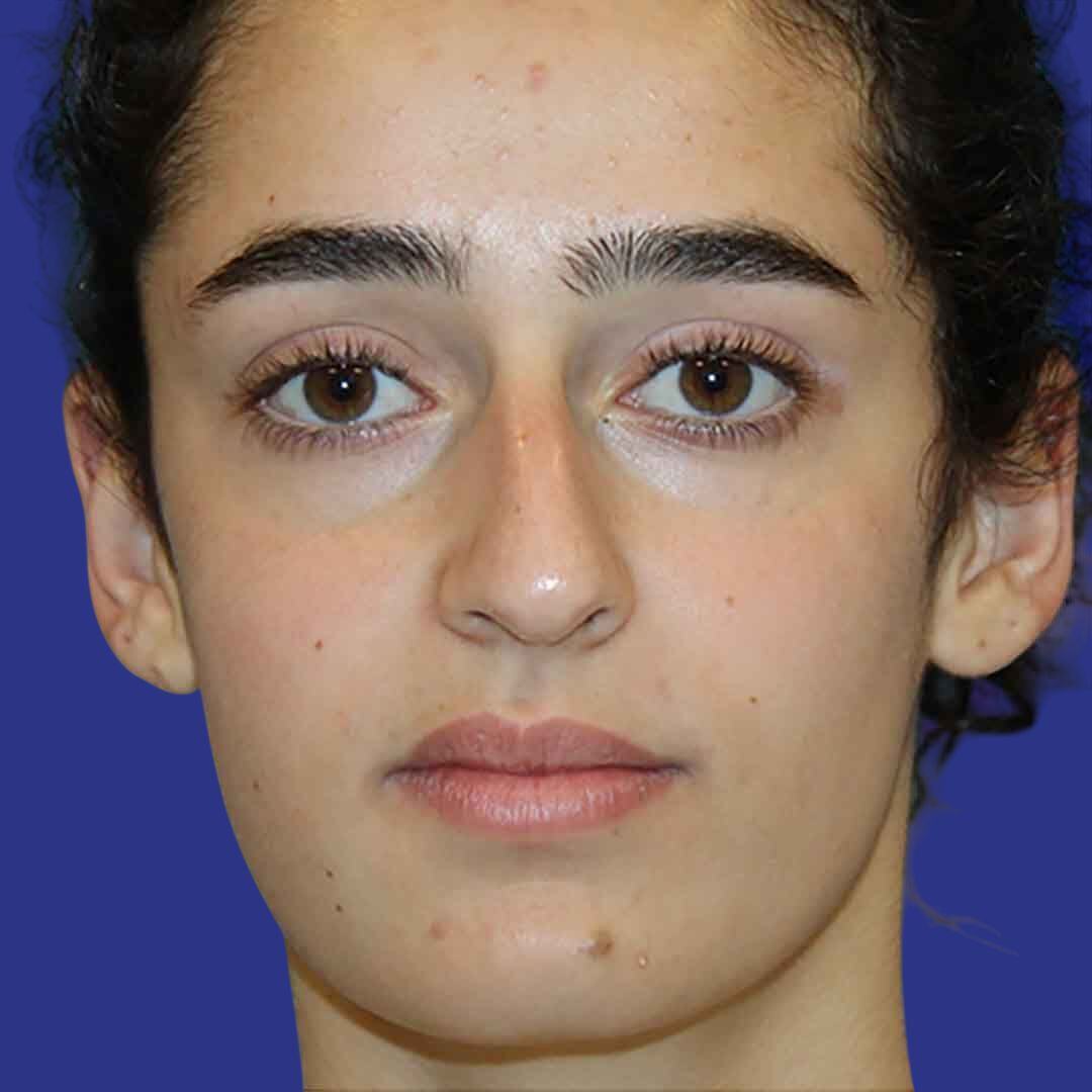 Procedure before and after - before