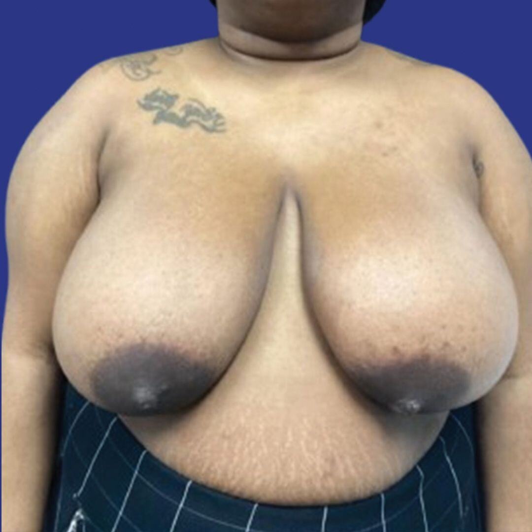 Procedure before and after - before
