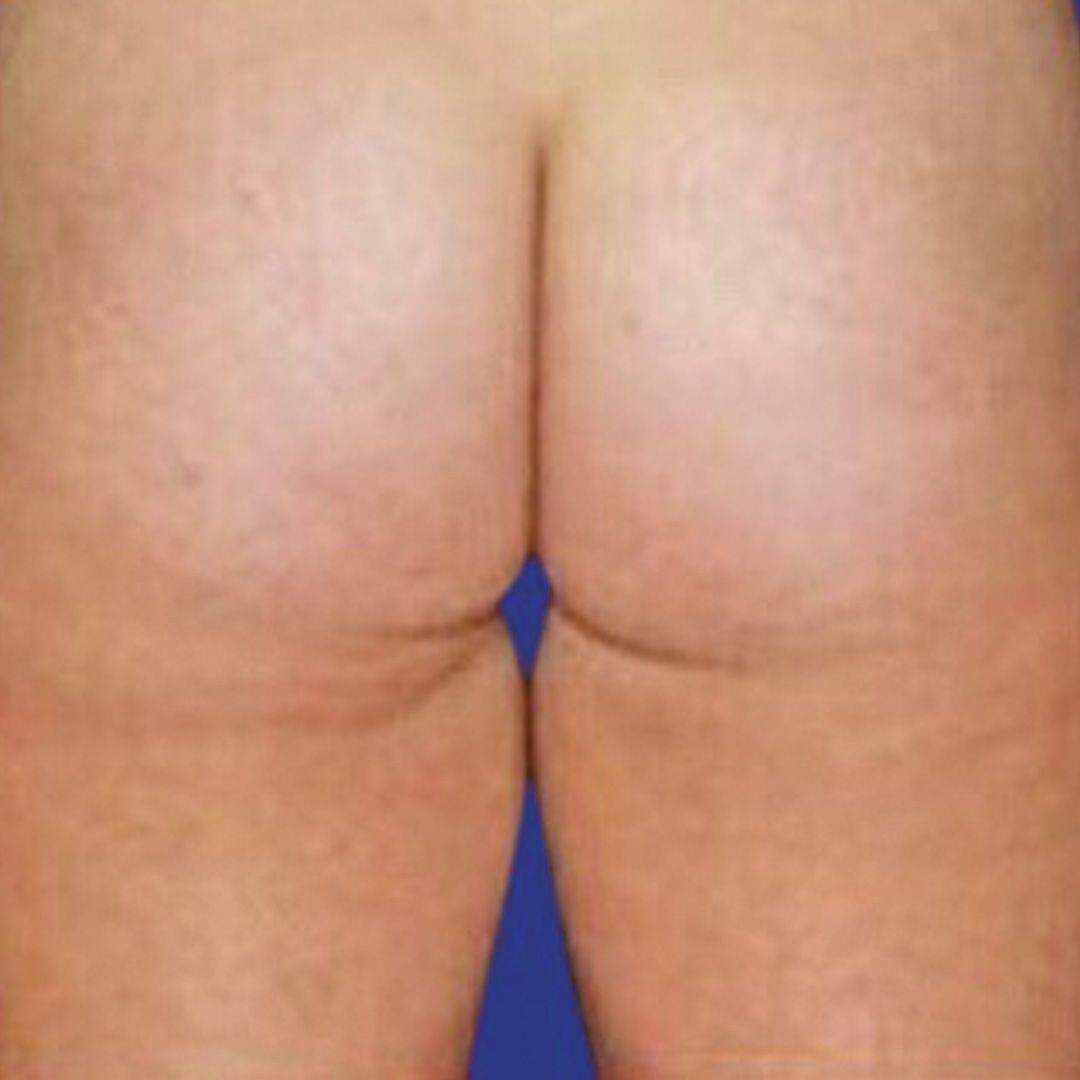 Procedure before and after - before