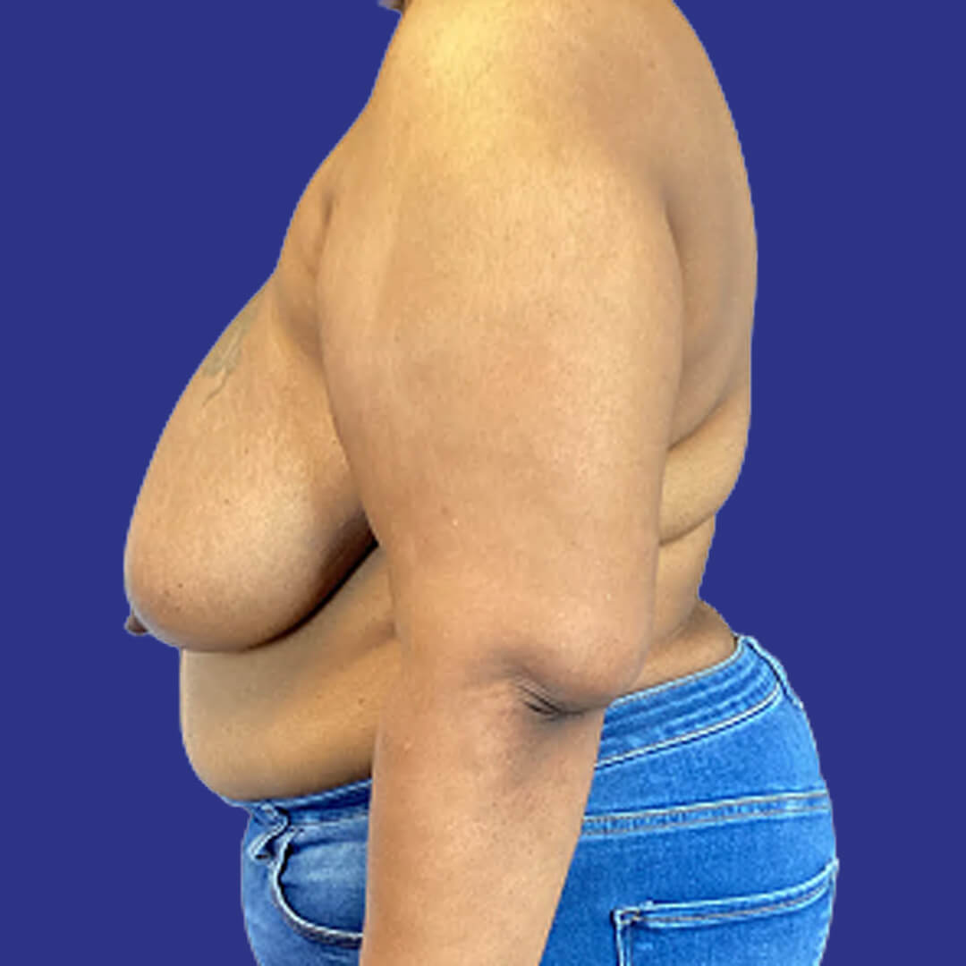 Procedure before and after - before