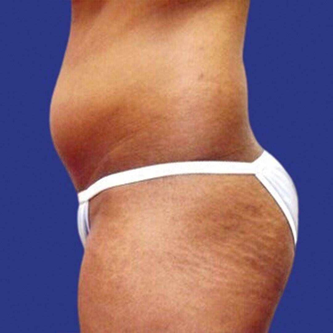 Procedure before and after - before