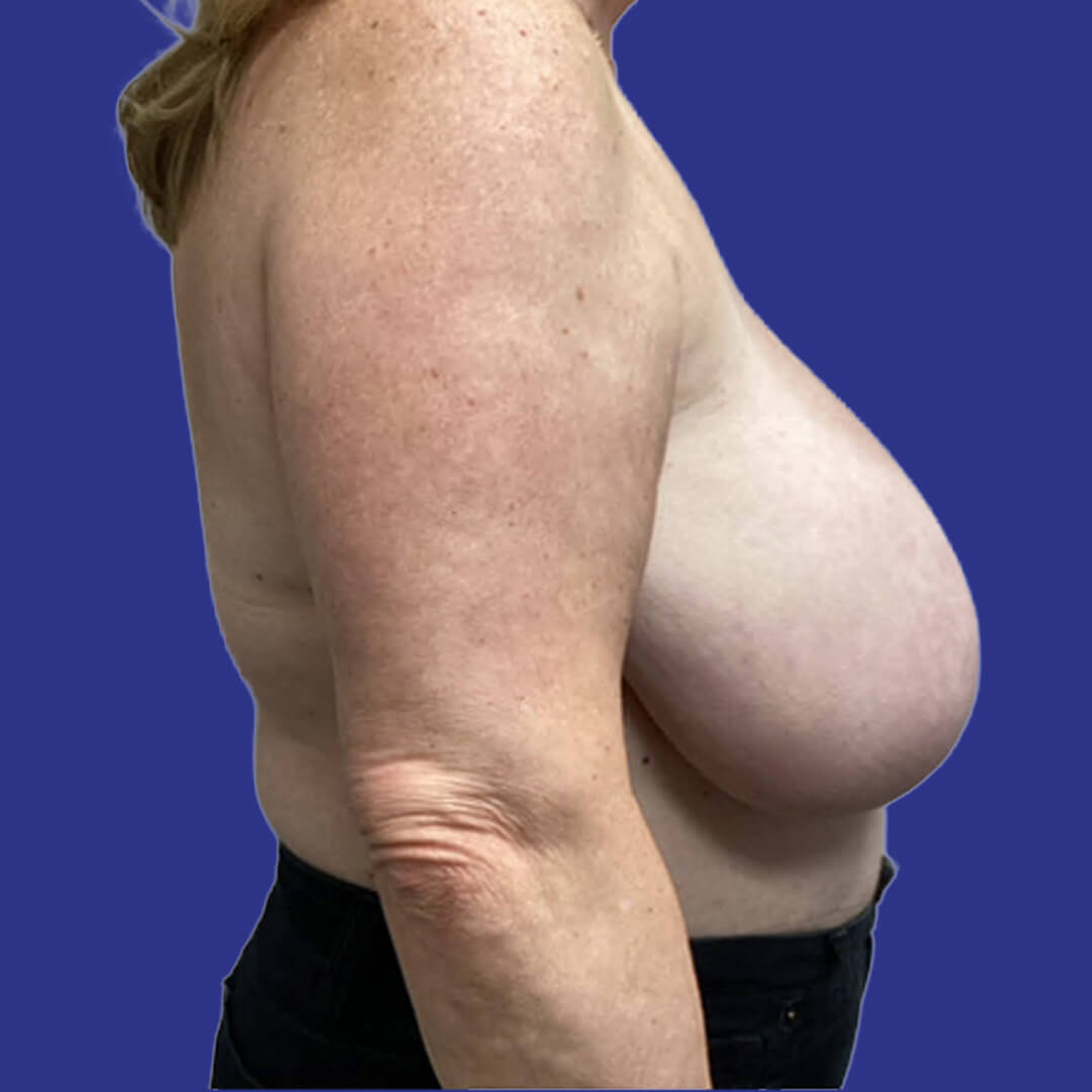 Procedure before and after - before
