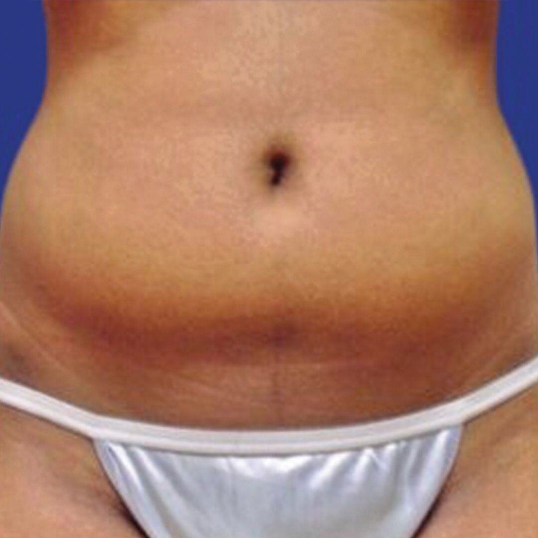 Procedure before and after - before