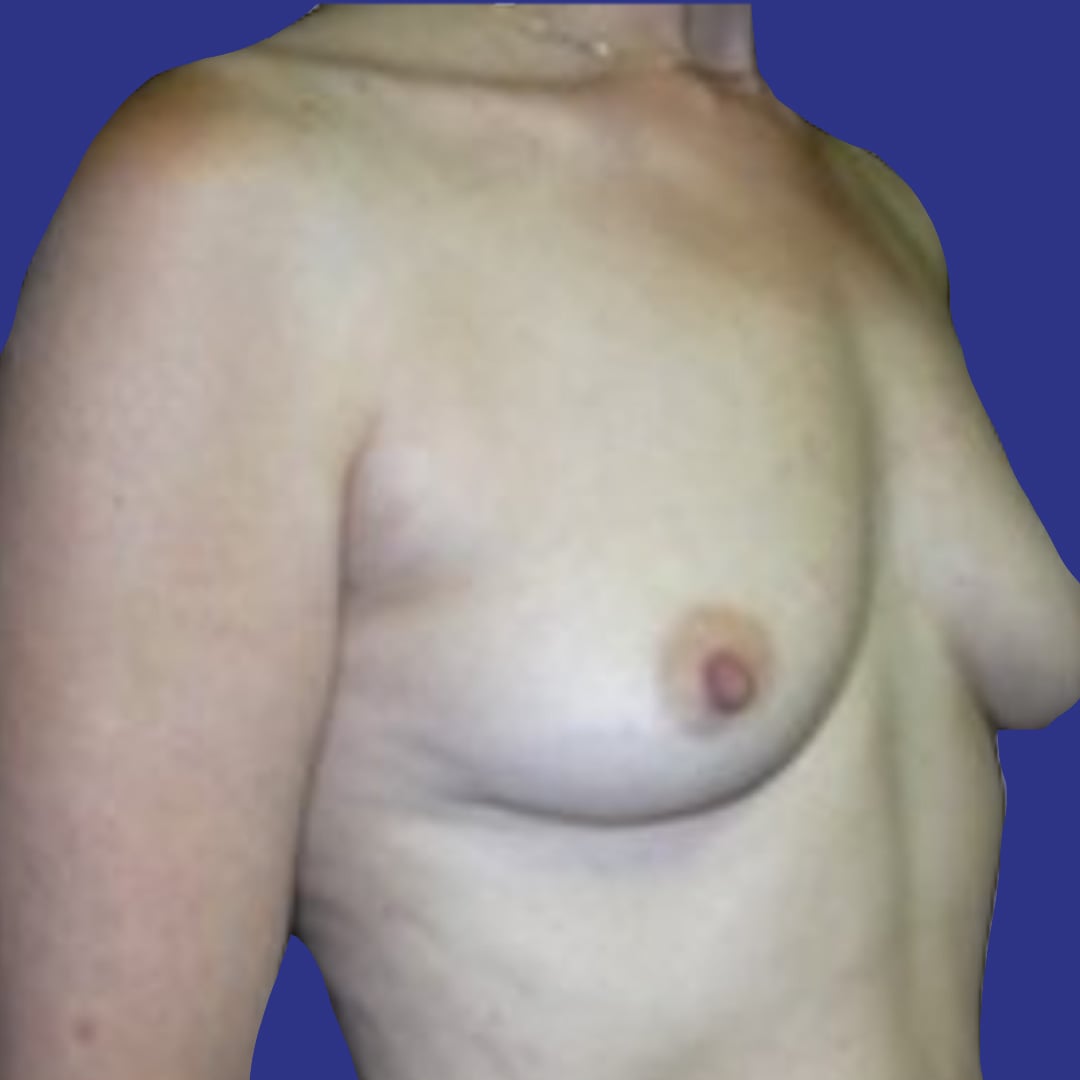 Procedure before and after - before