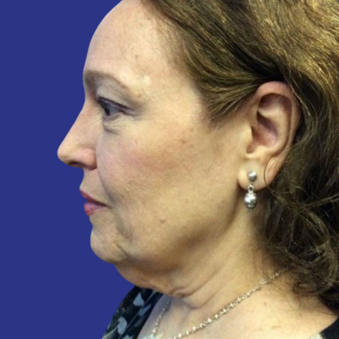 Procedure before and after - before