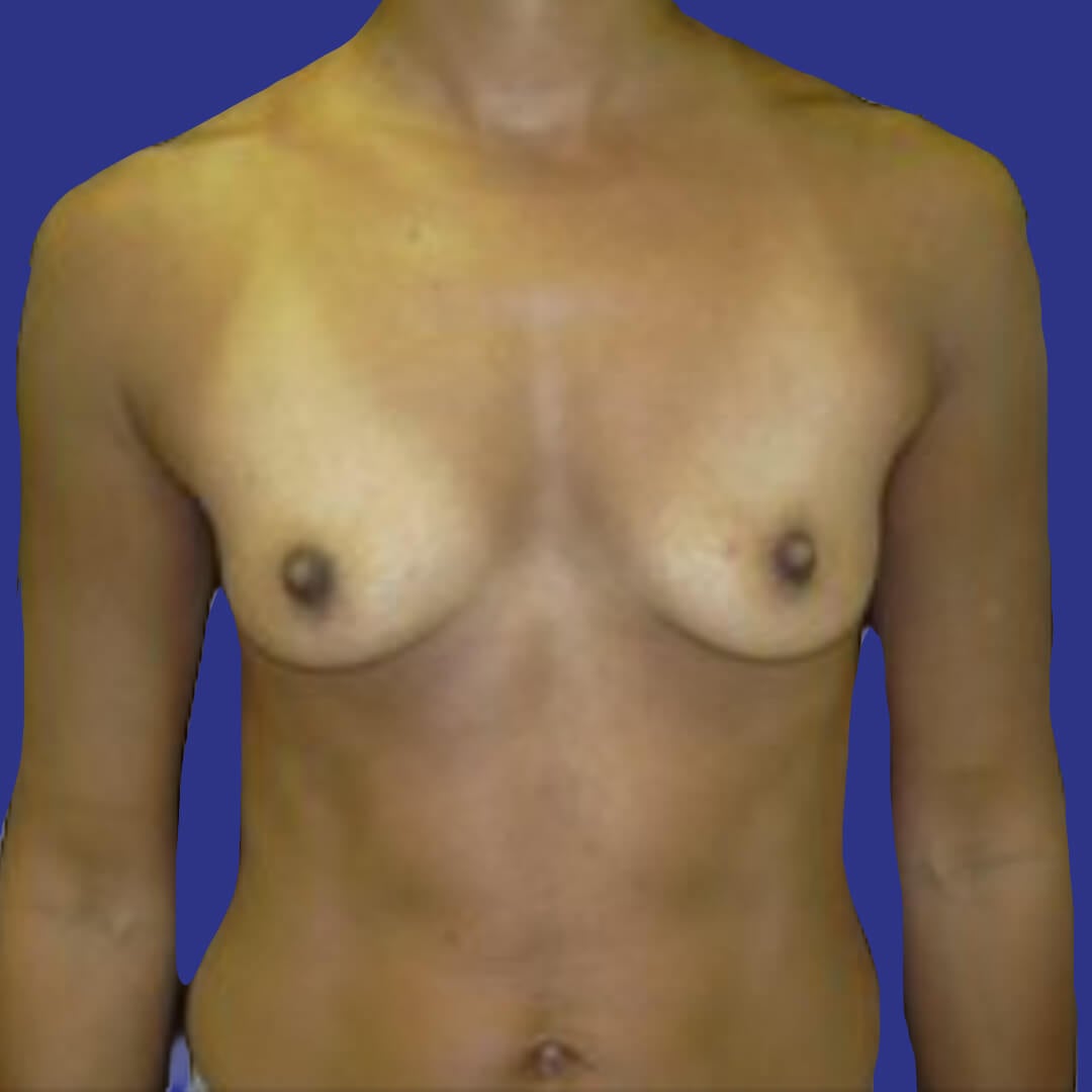 Procedure before and after - before
