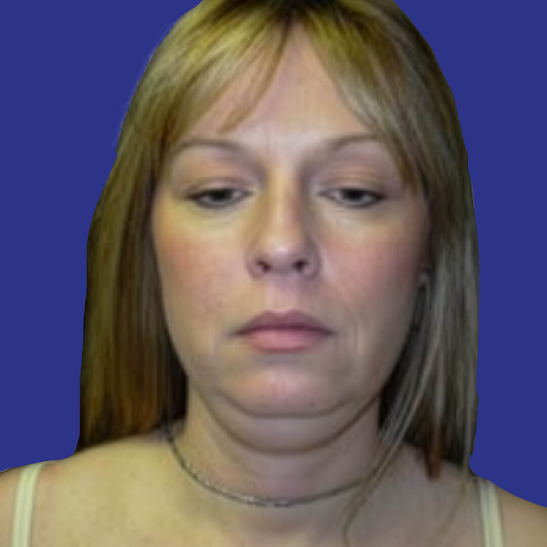 Procedure before and after - before