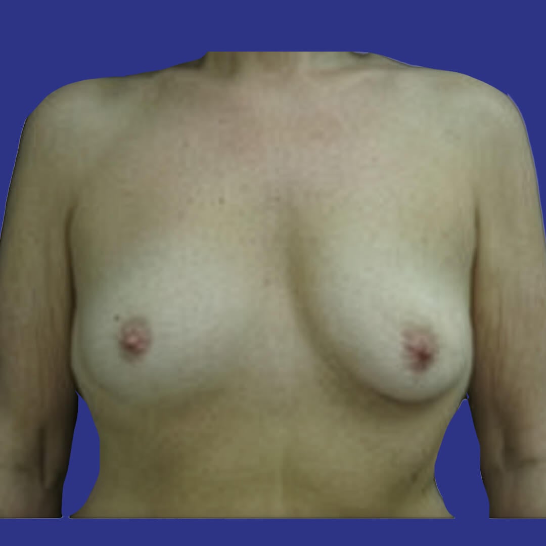 Procedure before and after - before