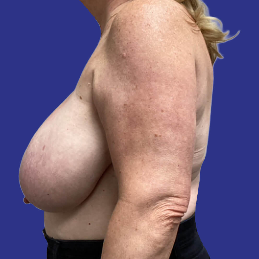 Procedure before and after - before