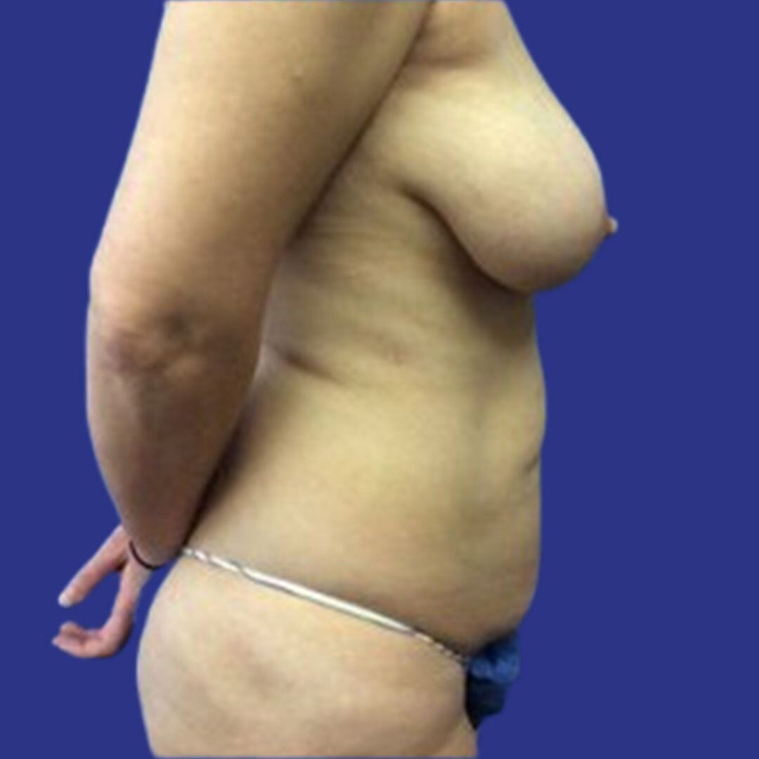 Procedure before and after - before