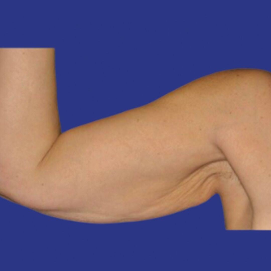 Procedure before and after - before
