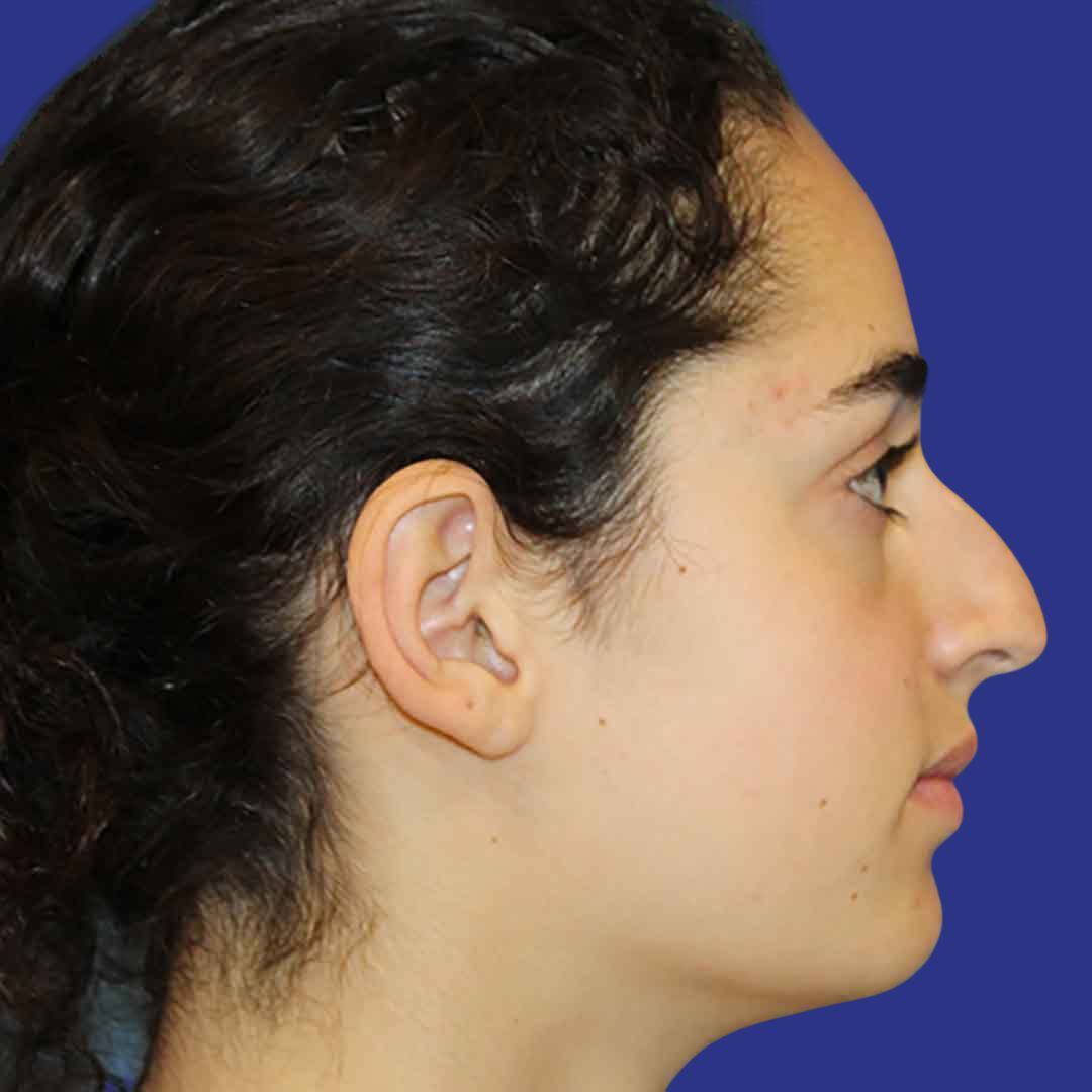 Procedure before and after - before