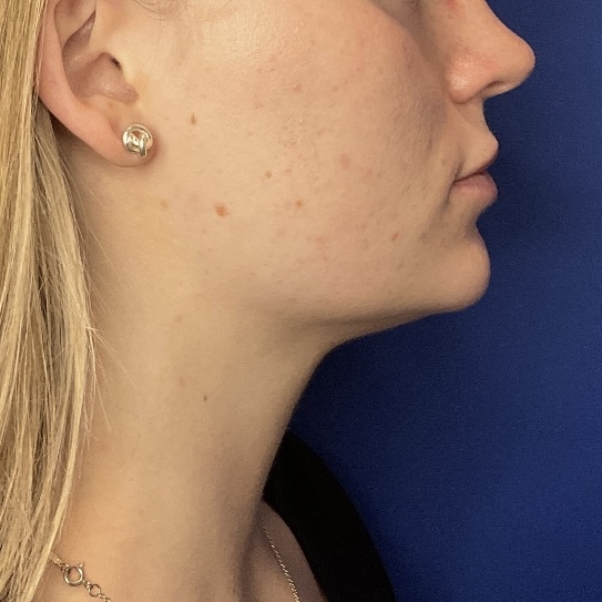 Liposuction before and after - after