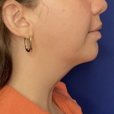 Liposuction before and after - after