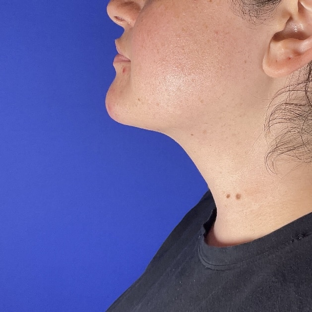 Liposuction before and after - after