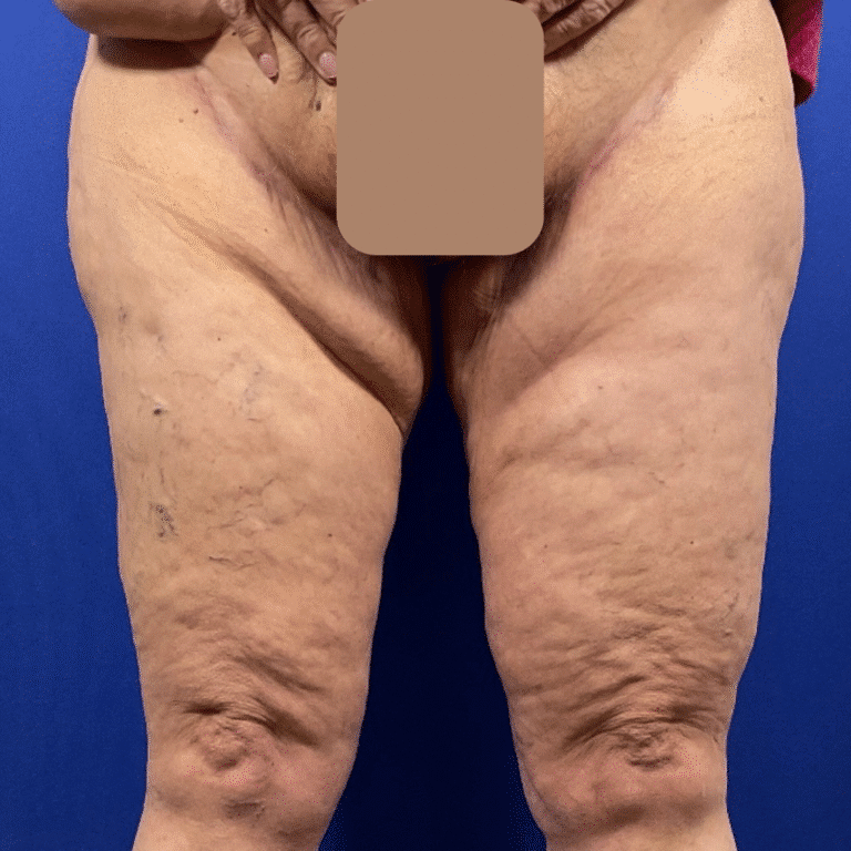 Thighplasty before and after - after