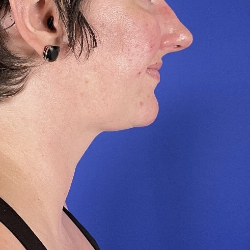Liposuction with FaceTite before and after - after