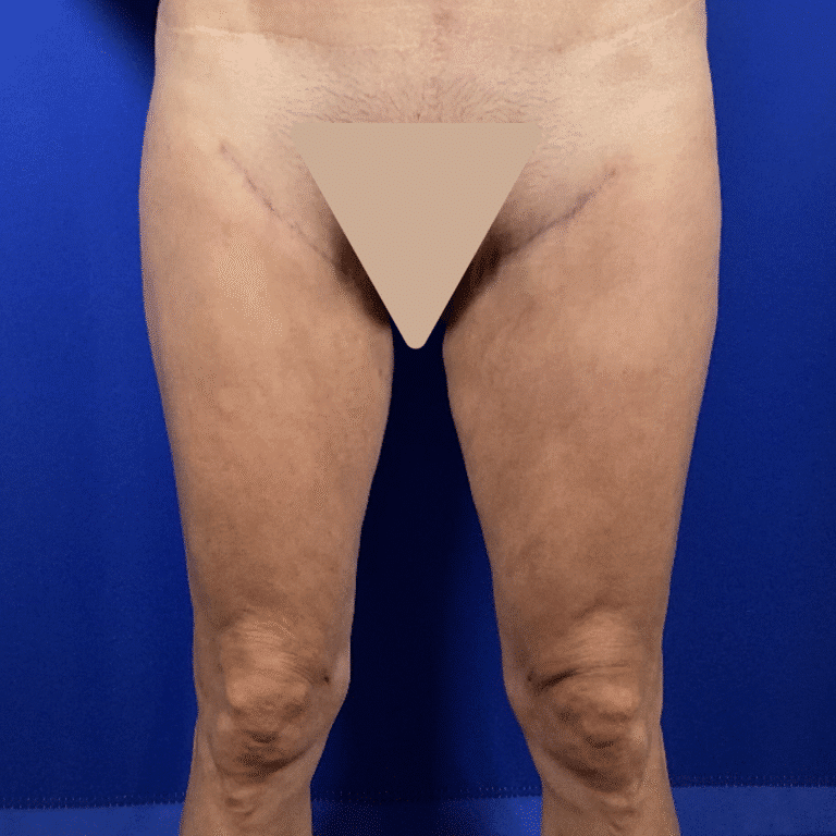 Thighplasty before and after - after