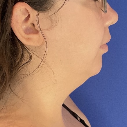 Liposuction before and after - before