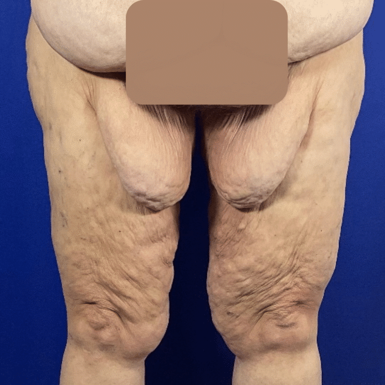 Thighplasty before and after - before