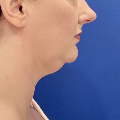 Liposuction with FaceTite before and after - before