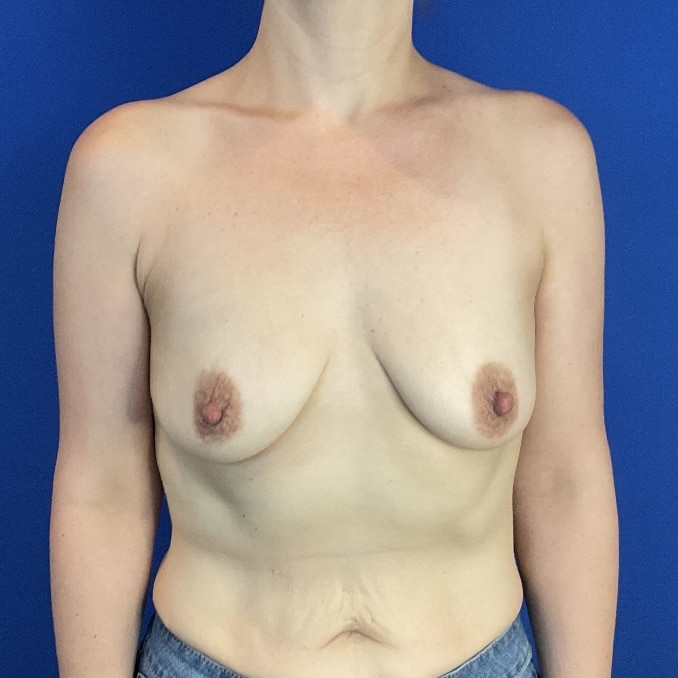Breast Augmentation before and after - before