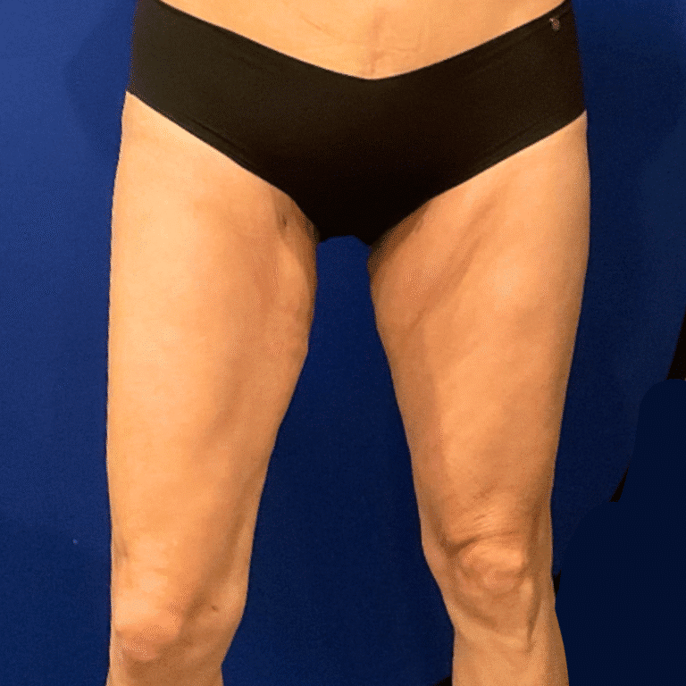 Thighplasty before and after - before