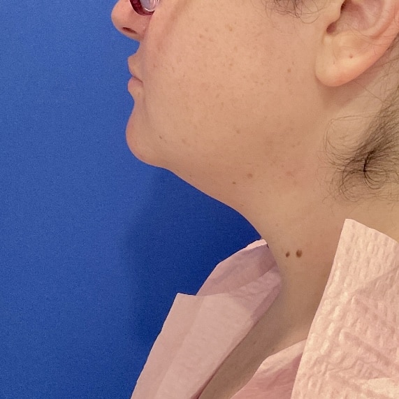 Liposuction before and after - before
