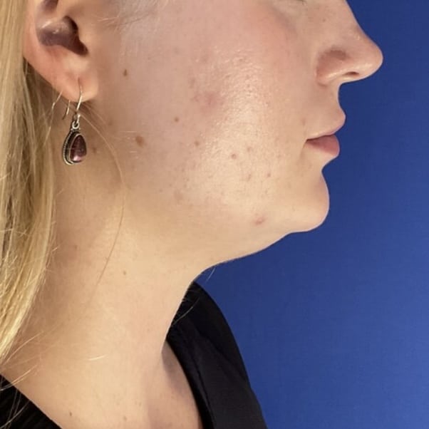 Liposuction before and after - before