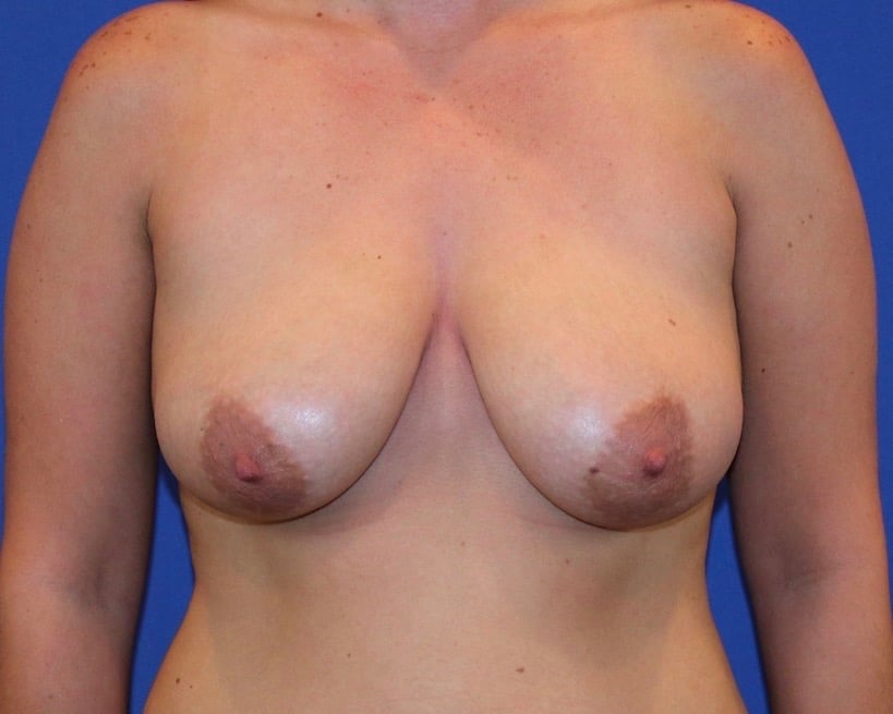 Breast Lift before and after - before