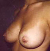 Breast Lift before and after - after