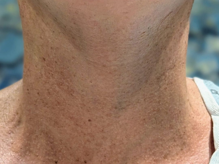 Facelift before and after - after